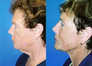 Profile Neck Lift Before & After Gallery - Patient 122406513 - Image 1