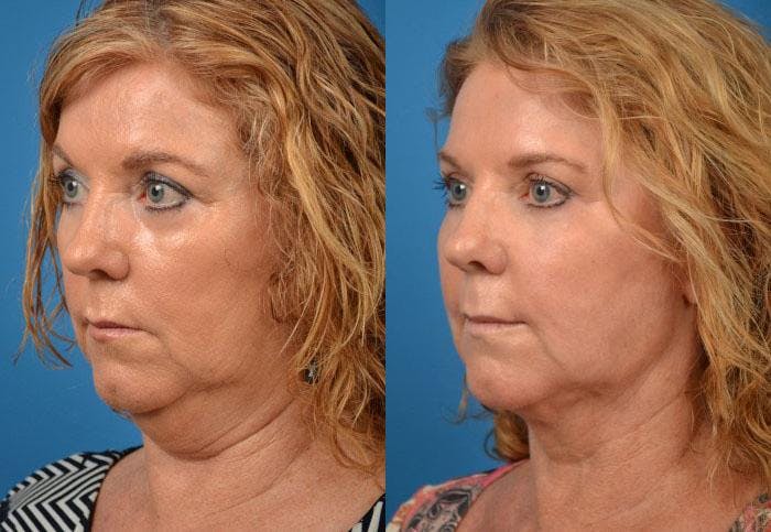 Laser Assisted Weekend Neck Lift Before & After Gallery - Patient 122406514 - Image 3