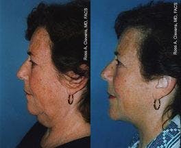 Profile Neck Lift Before & After Gallery - Patient 122406515 - Image 1