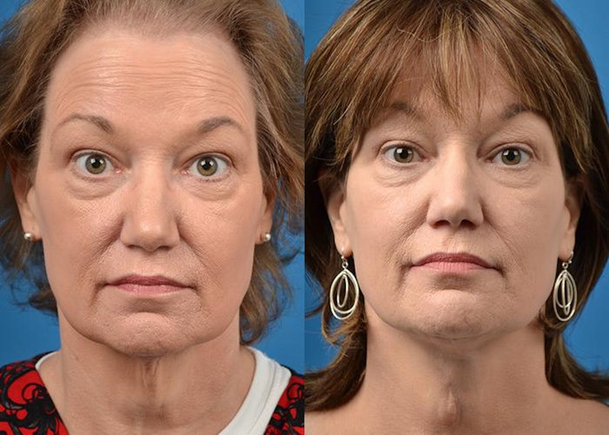 Profile Neck Lift Before & After Gallery - Patient 122406518 - Image 1