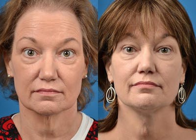 Profile Neck Lift Before & After Gallery - Patient 122406518 - Image 1