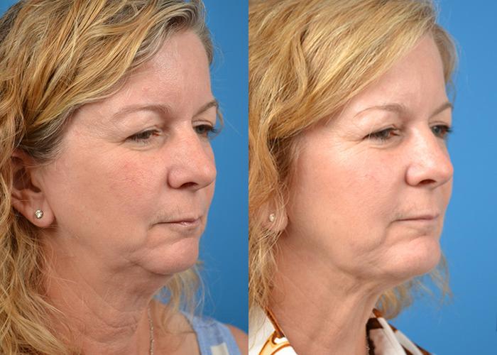 Laser Assisted Weekend Neck Lift Before & After Gallery - Patient 122406517 - Image 2