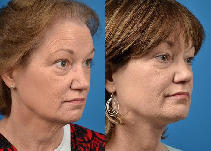 Profile Neck Lift Before & After Gallery - Patient 122406518 - Image 2