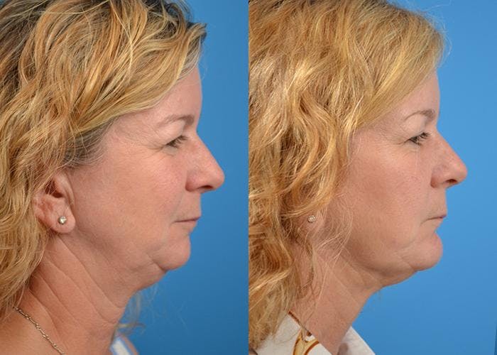 Laser Assisted Weekend Neck Lift Before & After Gallery - Patient 122406517 - Image 3