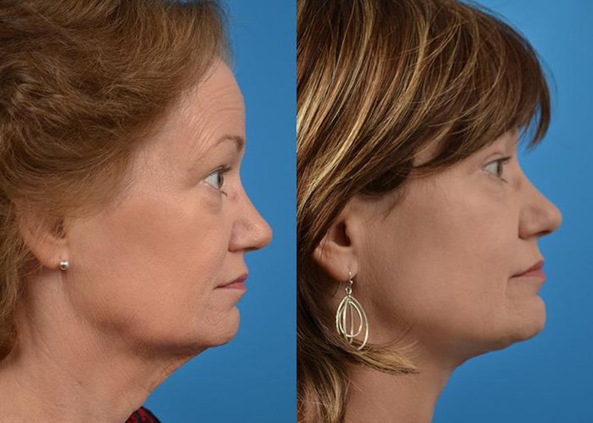 Profile Neck Lift Before & After Gallery - Patient 122406518 - Image 3