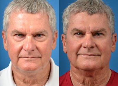 Laser Assisted Weekend Neck Lift Before & After Gallery - Patient 122406519 - Image 1