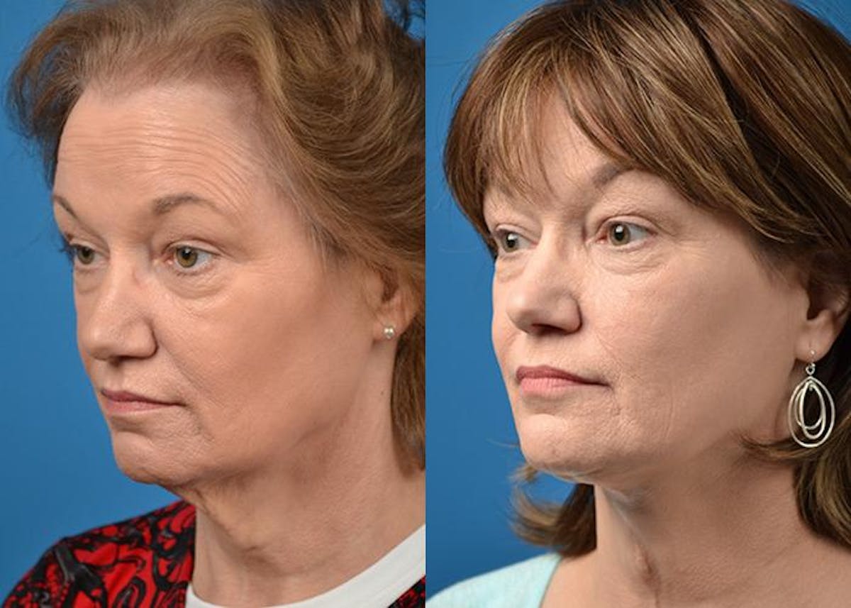 Profile Neck Lift Before & After Gallery - Patient 122406518 - Image 4