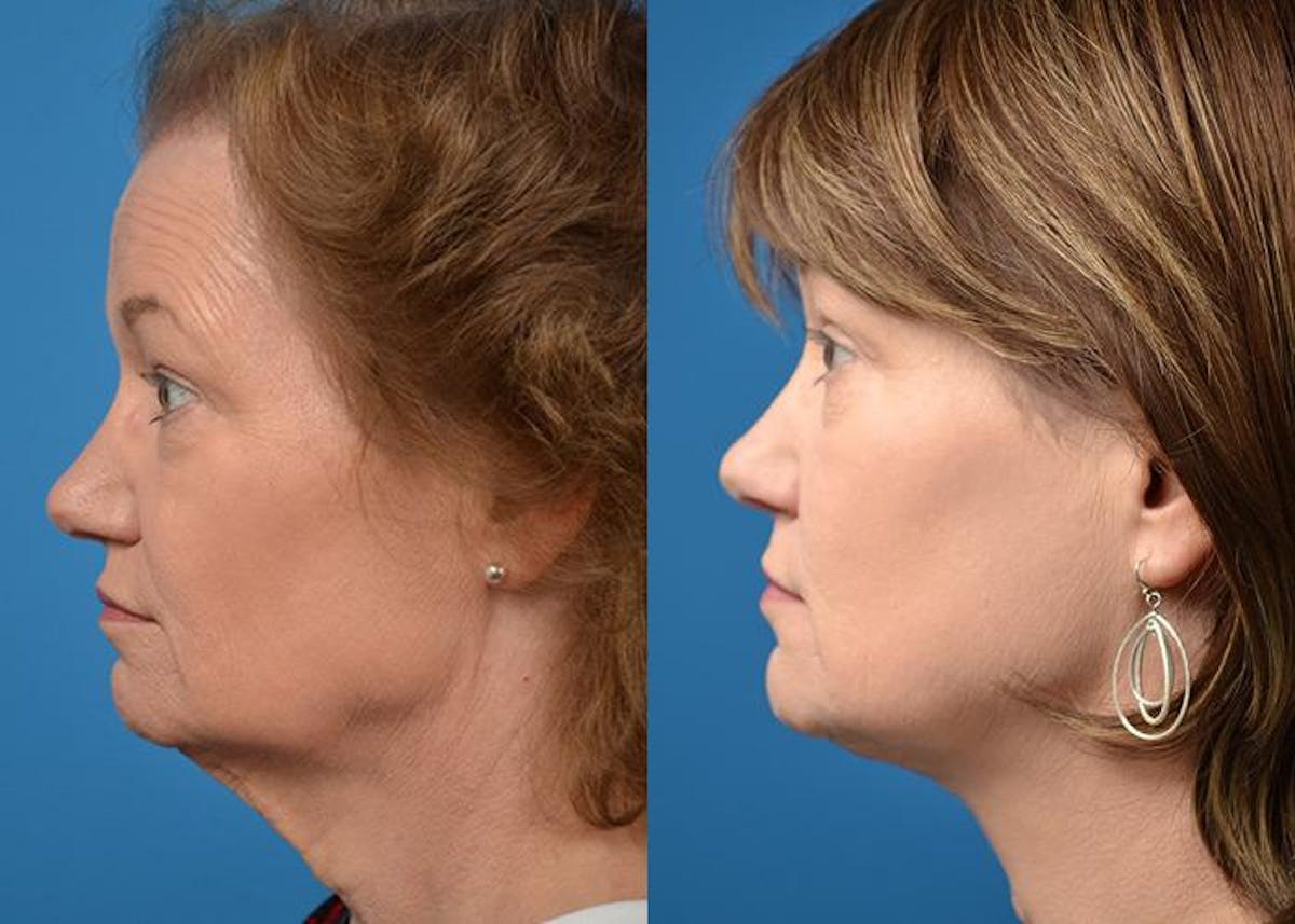 Profile Neck Lift Before & After Gallery - Patient 122406518 - Image 5