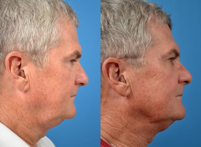 Laser Assisted Weekend Neck Lift Before & After Gallery - Patient 122406519 - Image 2