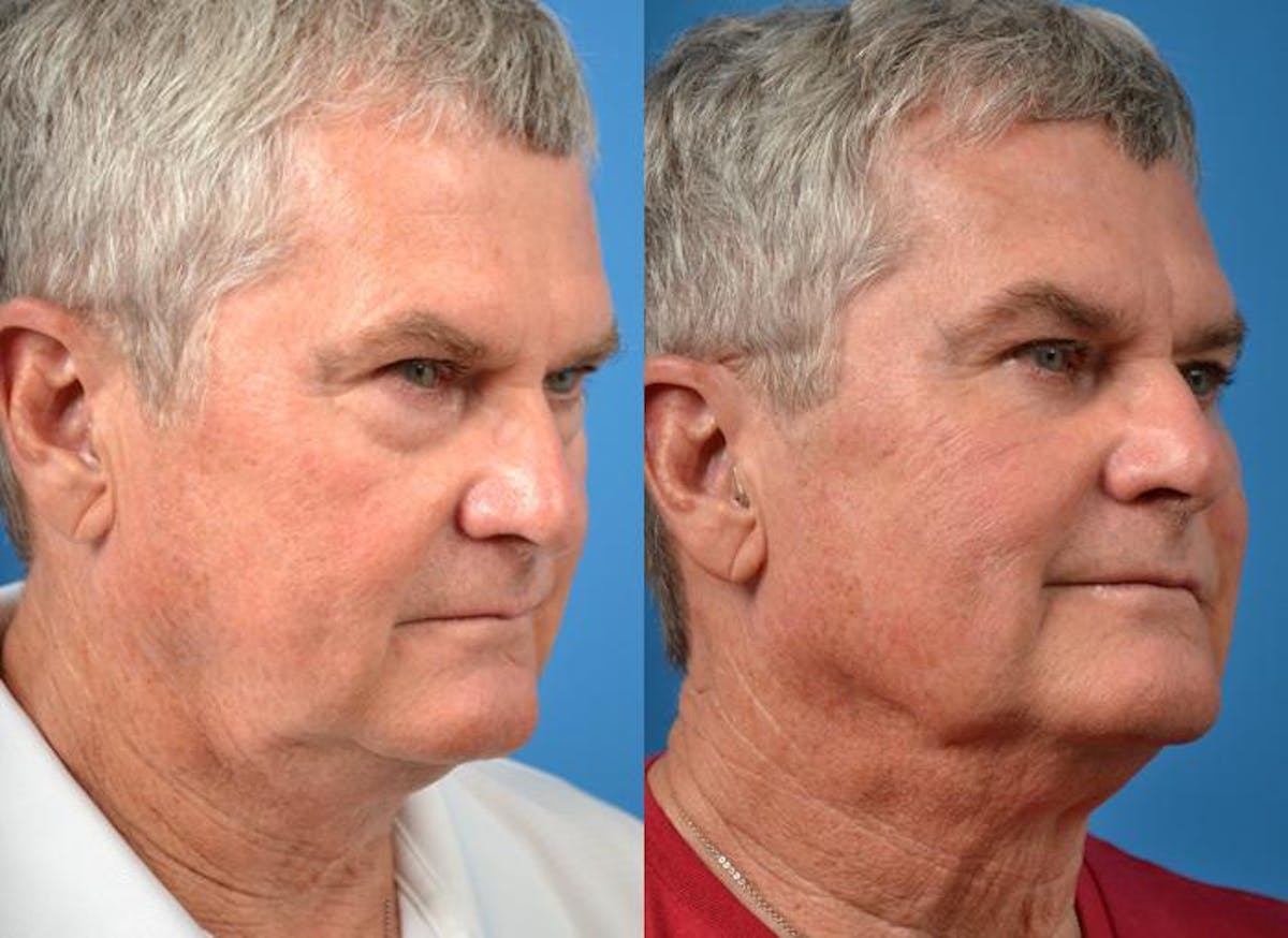 Laser Assisted Weekend Neck Lift Before & After Gallery - Patient 122406519 - Image 3