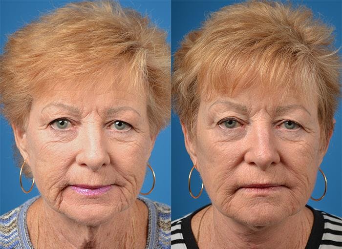 Profile Neck Lift Before & After Gallery - Patient 122406520 - Image 1