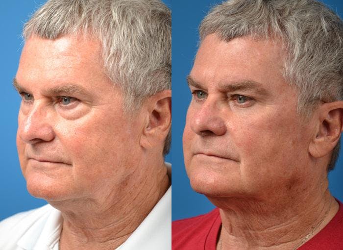 Laser Assisted Weekend Neck Lift Before & After Gallery - Patient 122406519 - Image 4