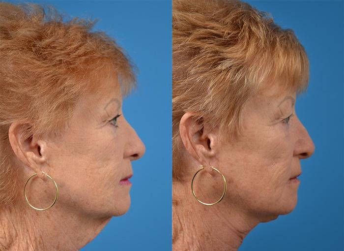 Profile Neck Lift Before & After Gallery - Patient 122406520 - Image 2