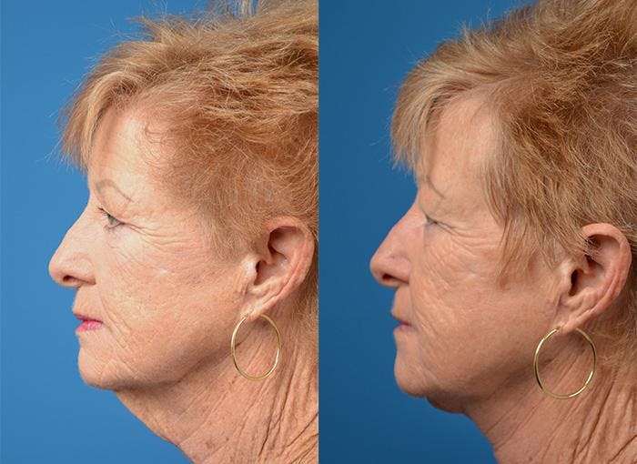 Profile Neck Lift Before & After Gallery - Patient 122406520 - Image 3