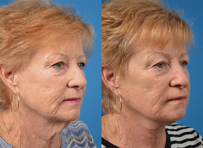 Profile Neck Lift Before & After Gallery - Patient 122406520 - Image 4