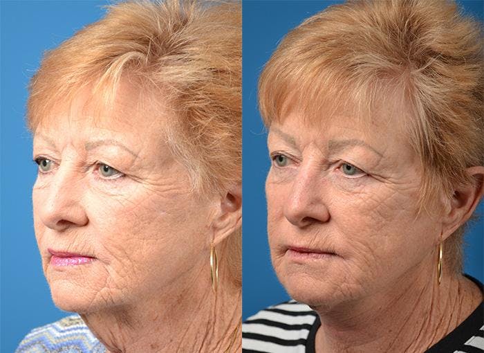 Profile Neck Lift Before & After Gallery - Patient 122406520 - Image 5