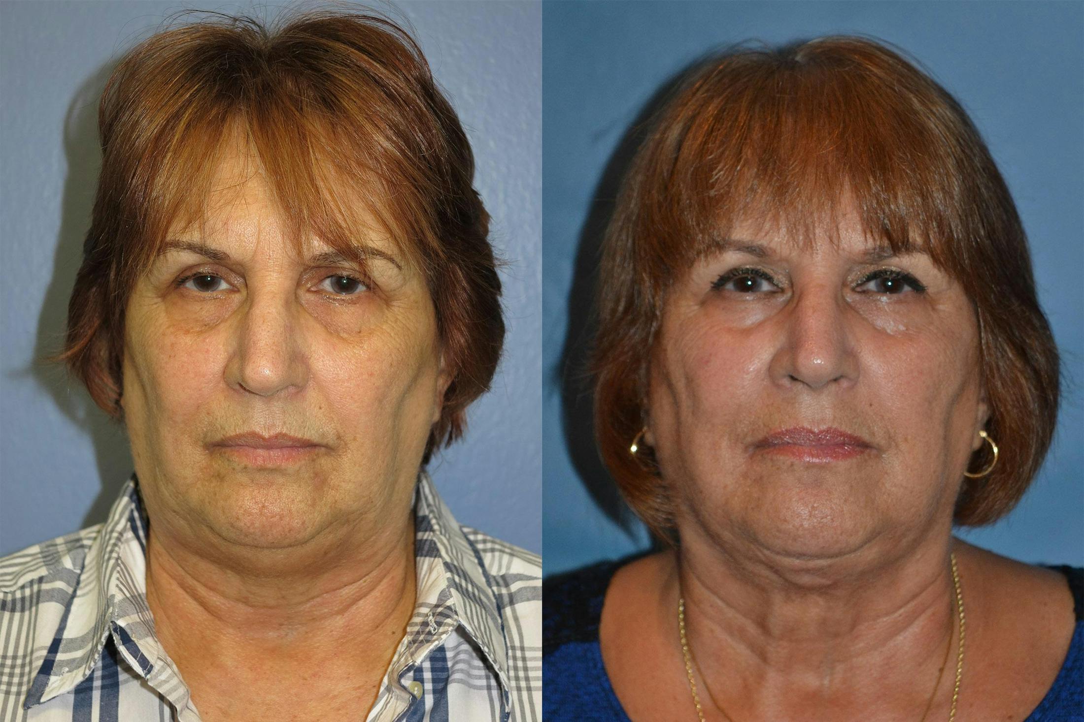 Profile Neck Lift Before & After Gallery - Patient 122406526 - Image 1