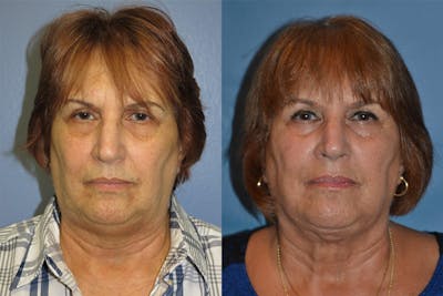 Profile Neck Lift Before & After Gallery - Patient 122406526 - Image 1