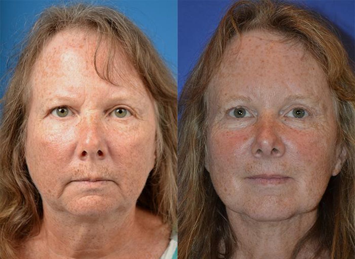 Laser Assisted Weekend Neck Lift Before & After Gallery - Patient 122406522 - Image 1