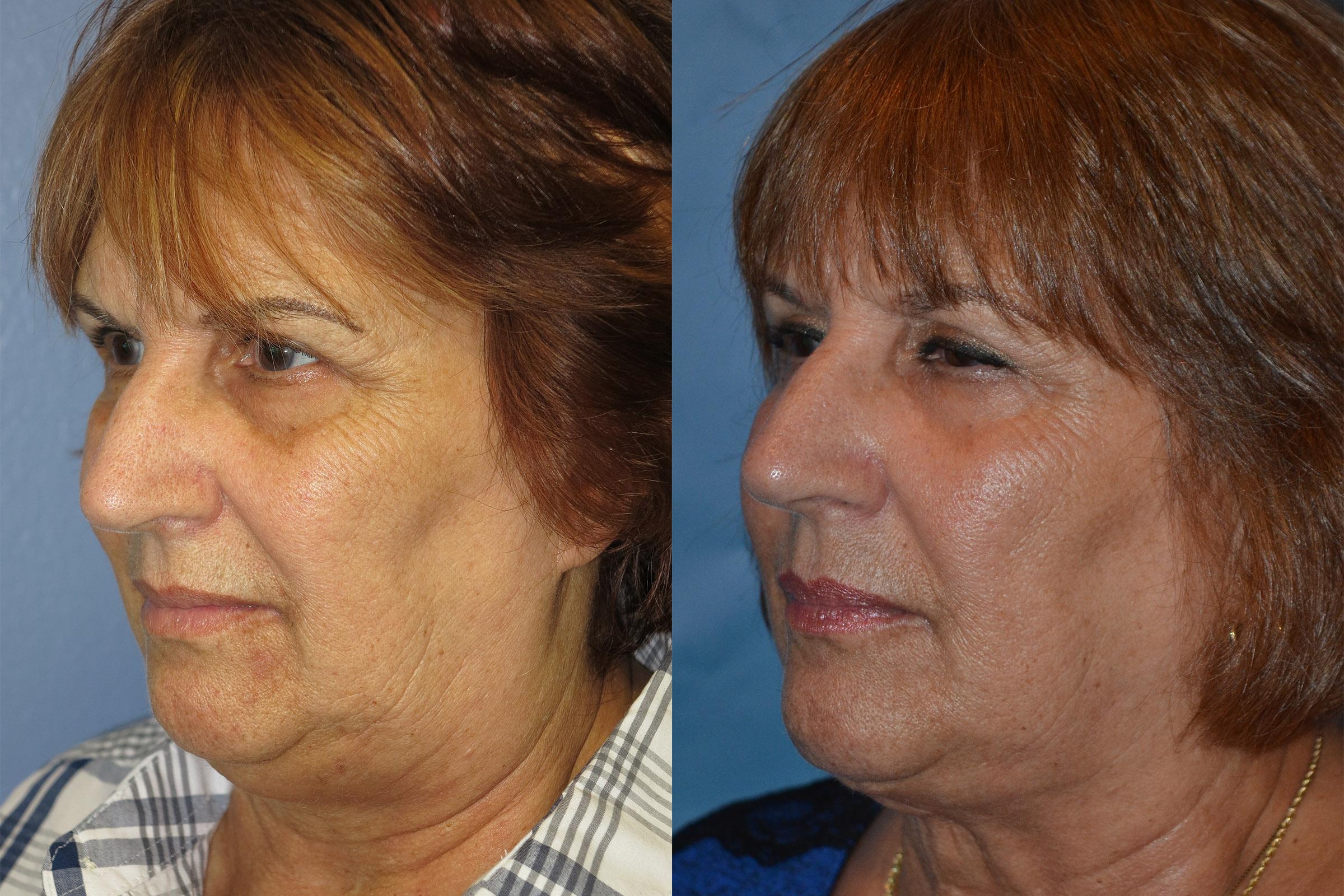 Profile Neck Lift Before & After Gallery - Patient 122406526 - Image 2