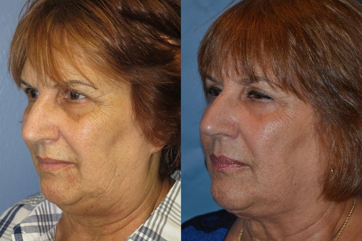 Profile Neck Lift Before & After Gallery - Patient 122406526 - Image 2