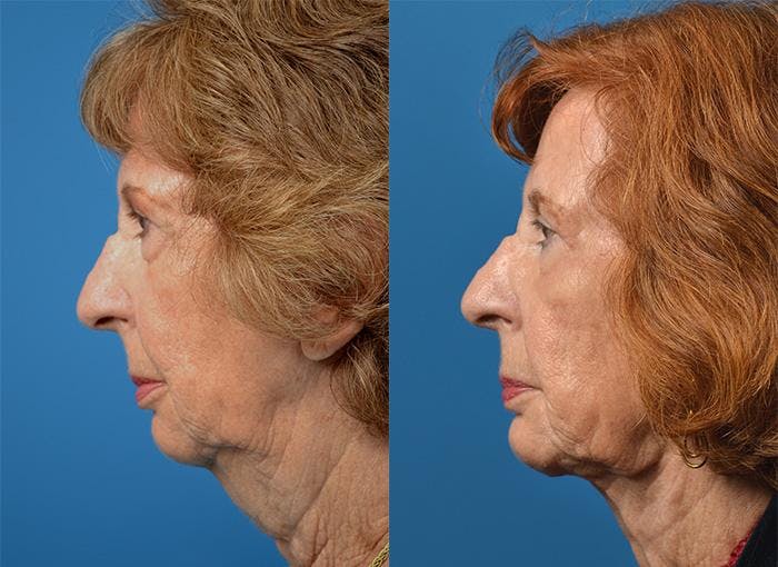 Laser Assisted Weekend Neck Lift Before & After Gallery - Patient 122406524 - Image 1