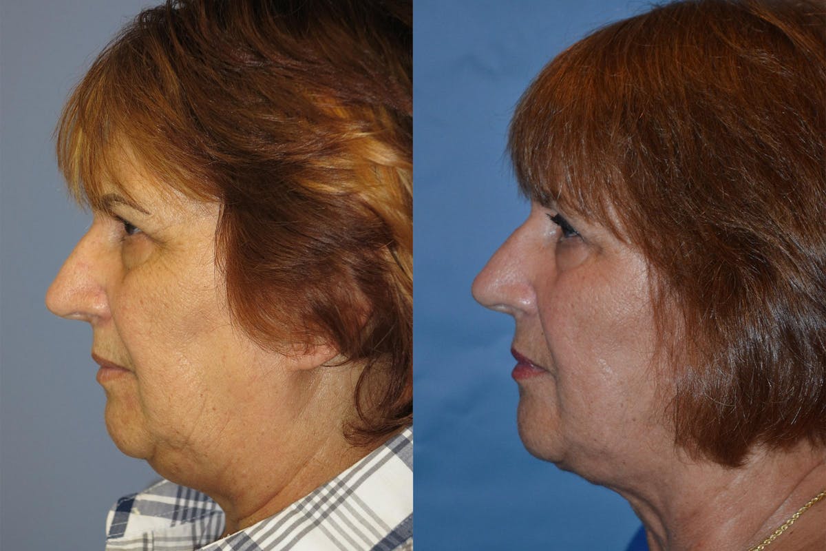 Profile Neck Lift Before & After Gallery - Patient 122406526 - Image 3