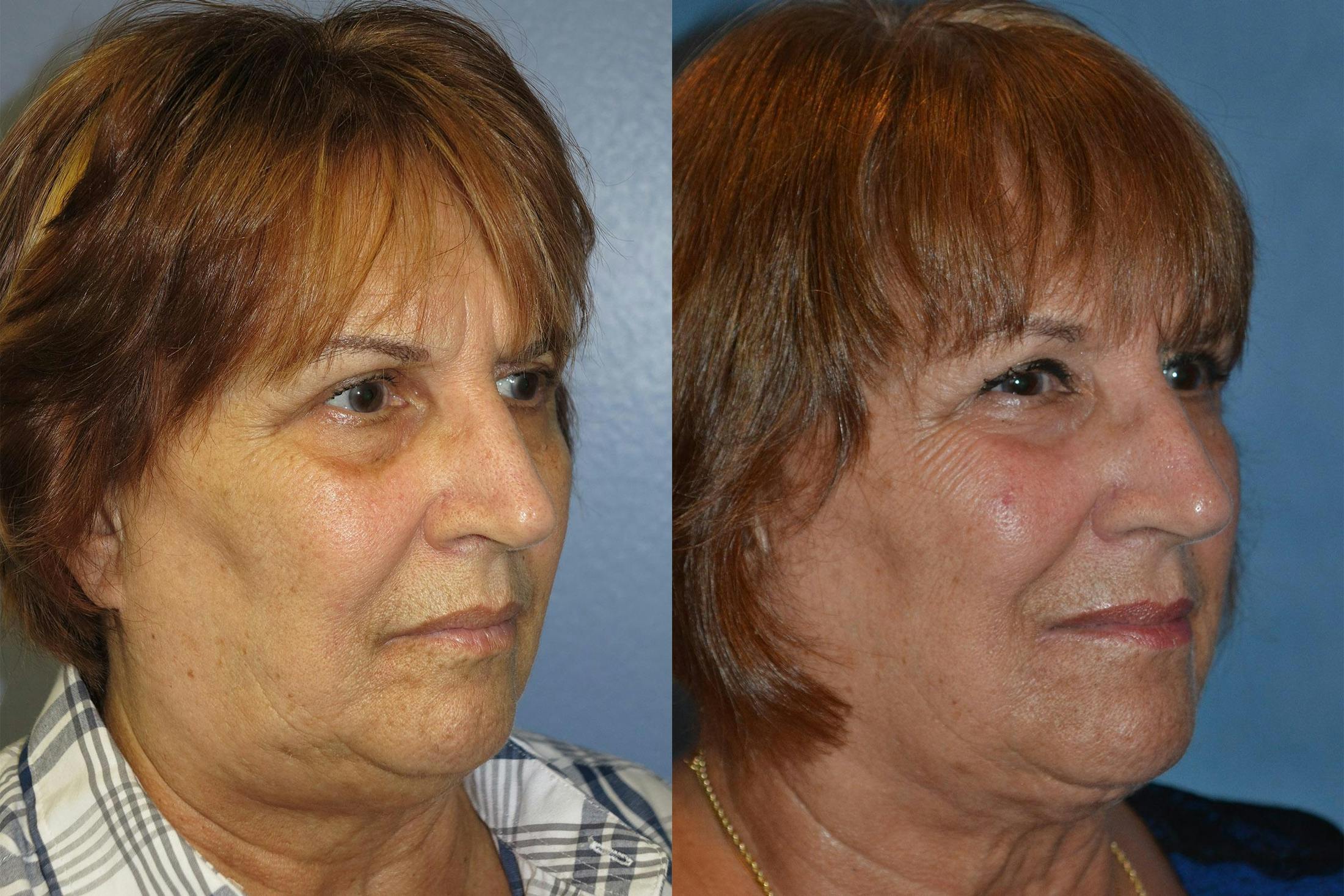 Profile Neck Lift Before & After Gallery - Patient 122406526 - Image 4