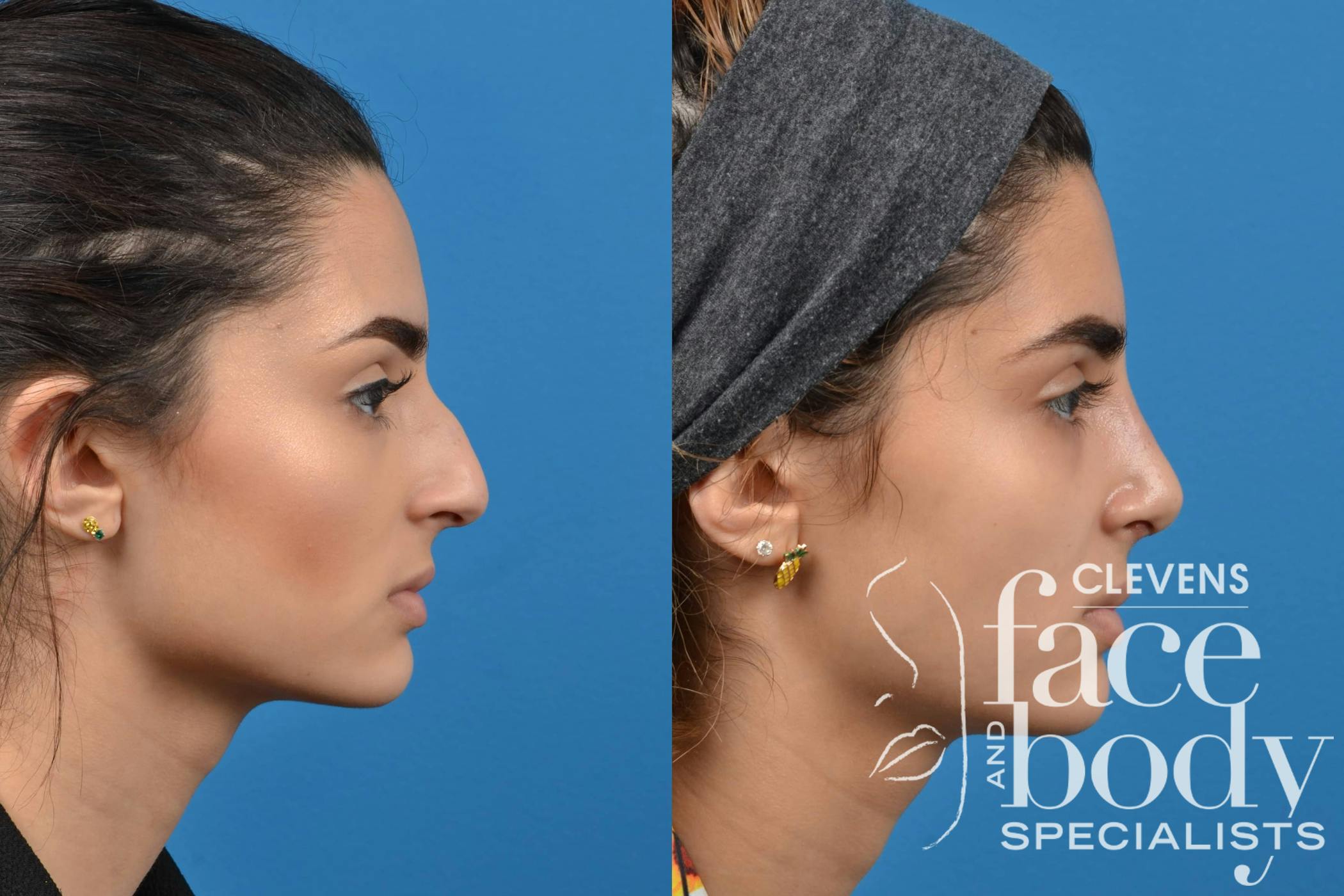 Rhinoplasty Procedure