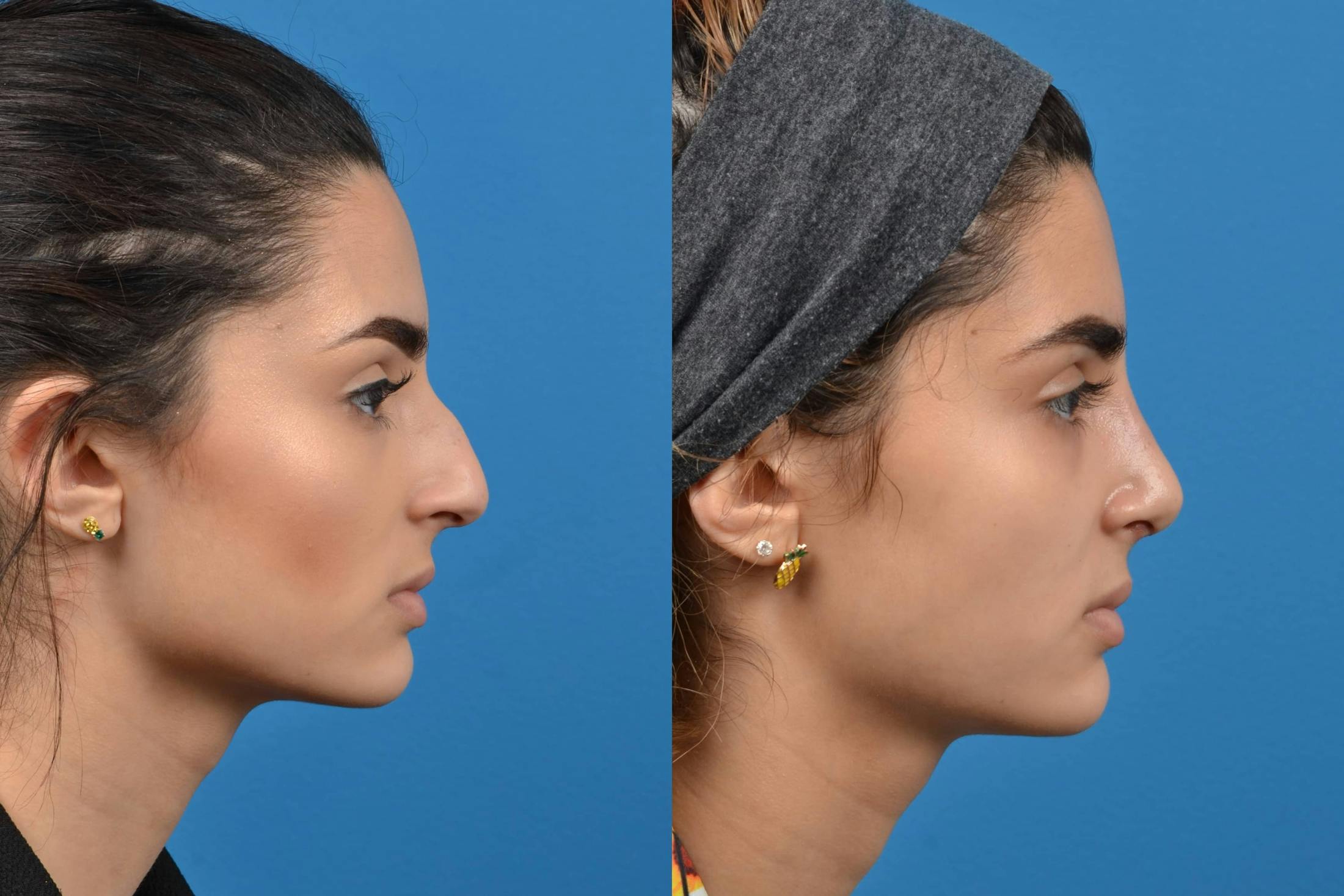 Rhinoplasty Before & After Gallery - Patient 122406535 - Image 1