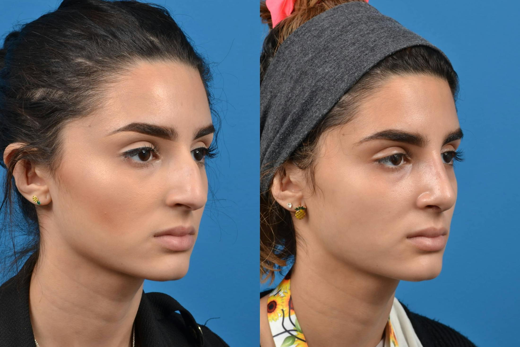 Rhinoplasty Before & After Gallery - Patient 122406535 - Image 2