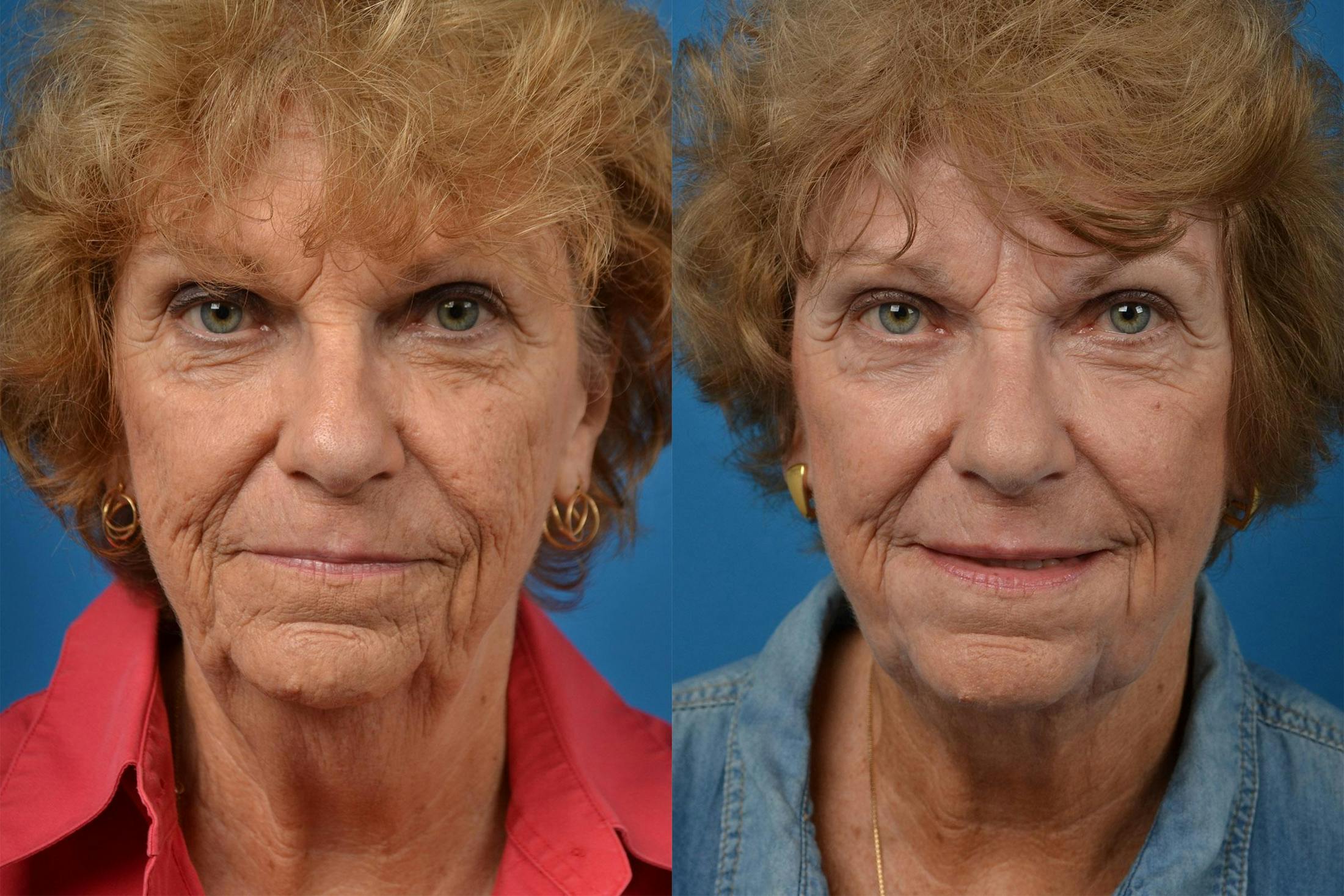 Profile Neck Lift Before & After Gallery - Patient 122406534 - Image 1