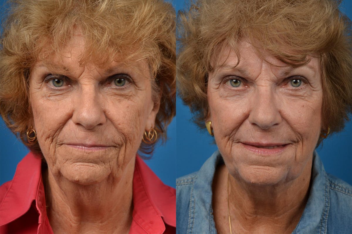 Profile Neck Lift Before & After Gallery - Patient 122406534 - Image 1
