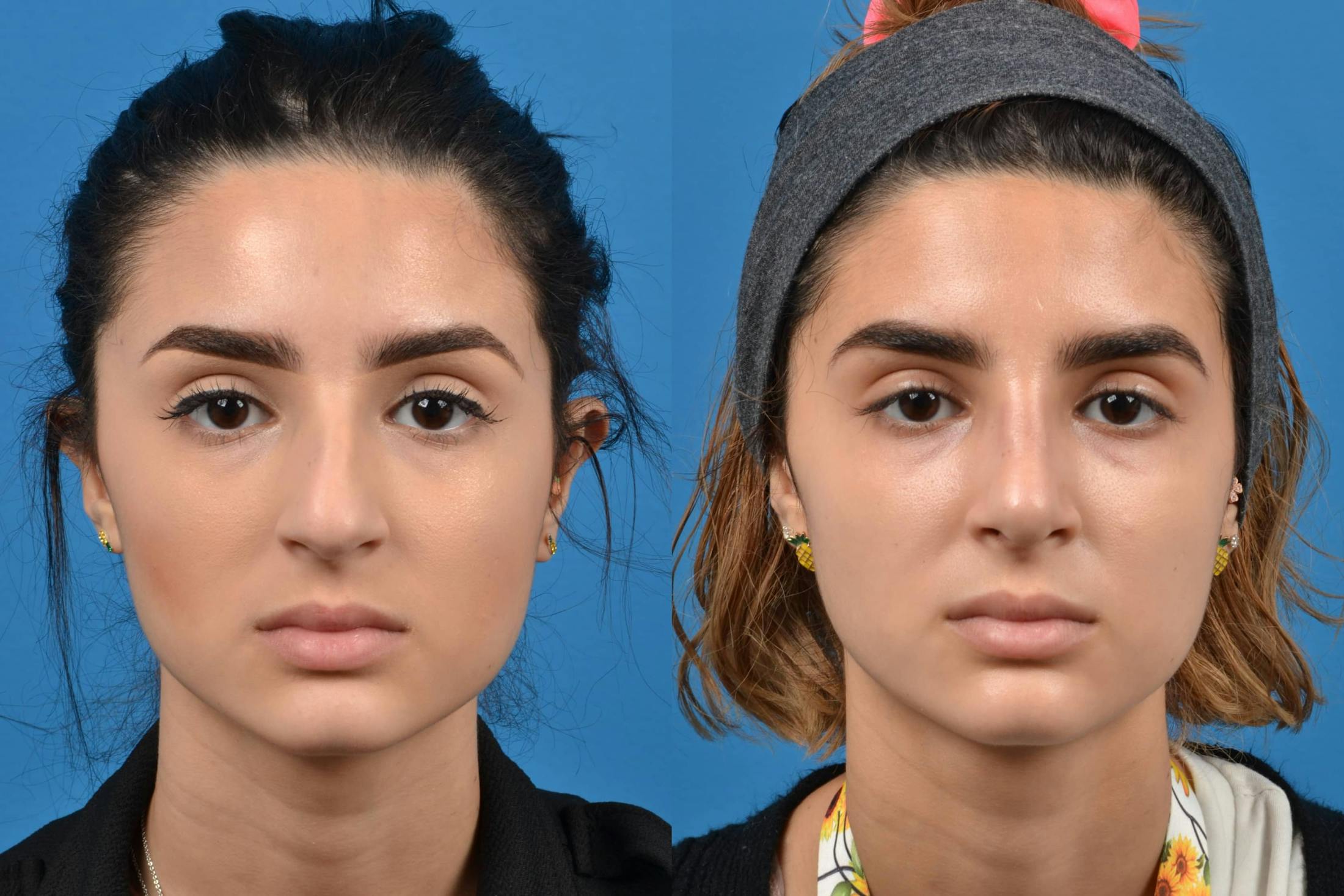 Rhinoplasty Before & After Gallery - Patient 122406535 - Image 3
