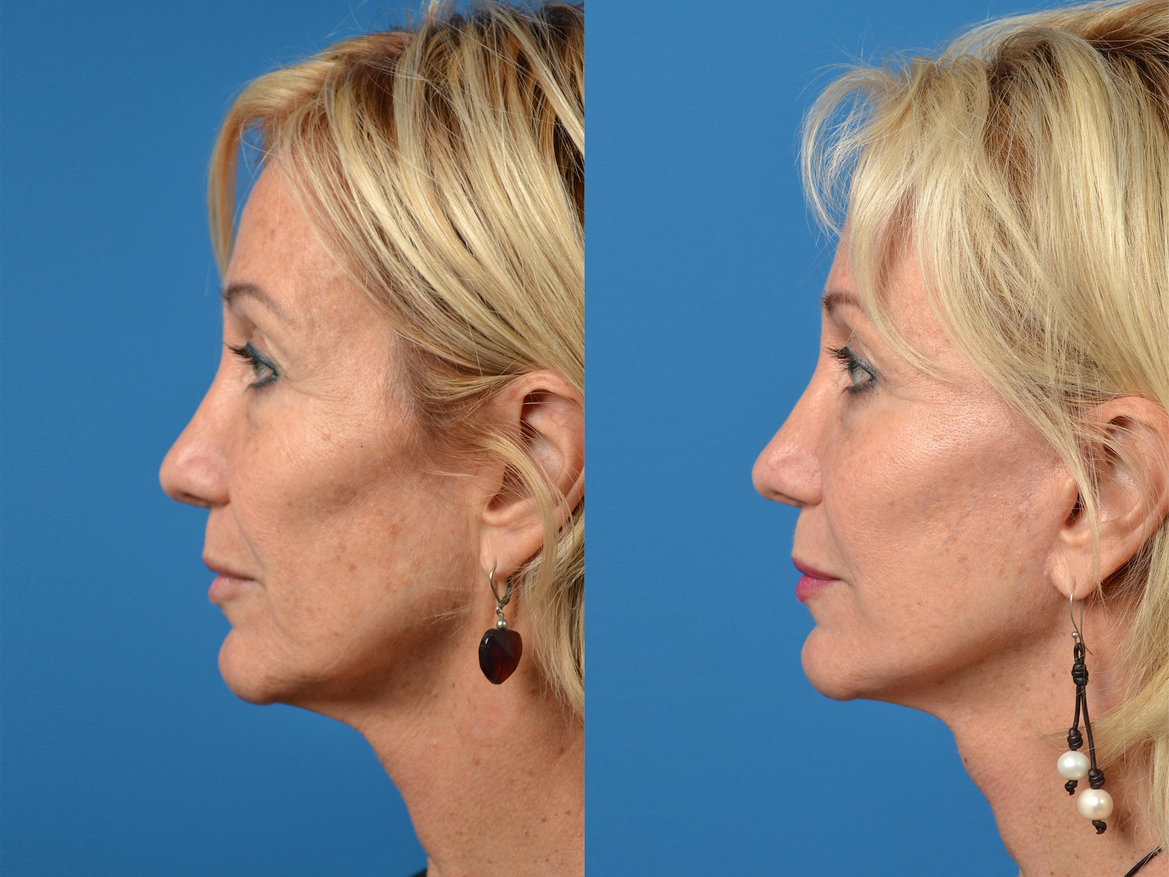 Laser Assisted Weekend Neck Lift Before & After Gallery - Patient 122406533 - Image 3