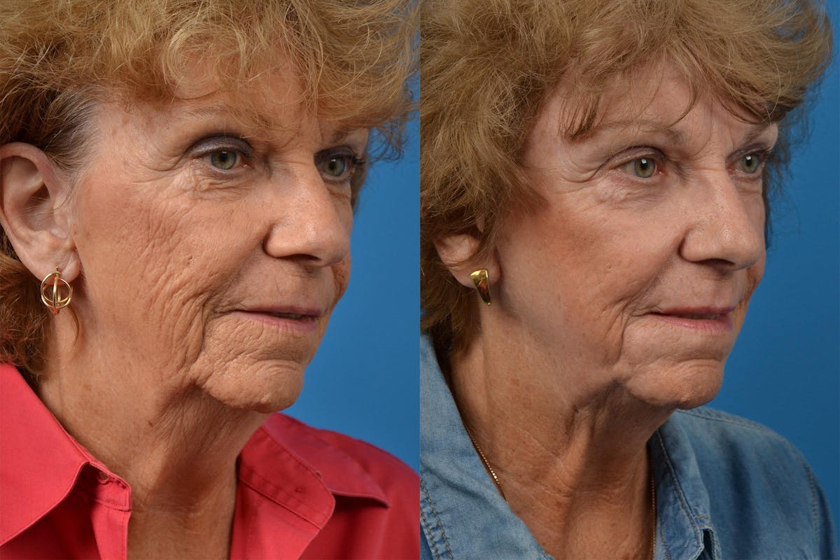 Profile Neck Lift Before & After Gallery - Patient 122406534 - Image 2