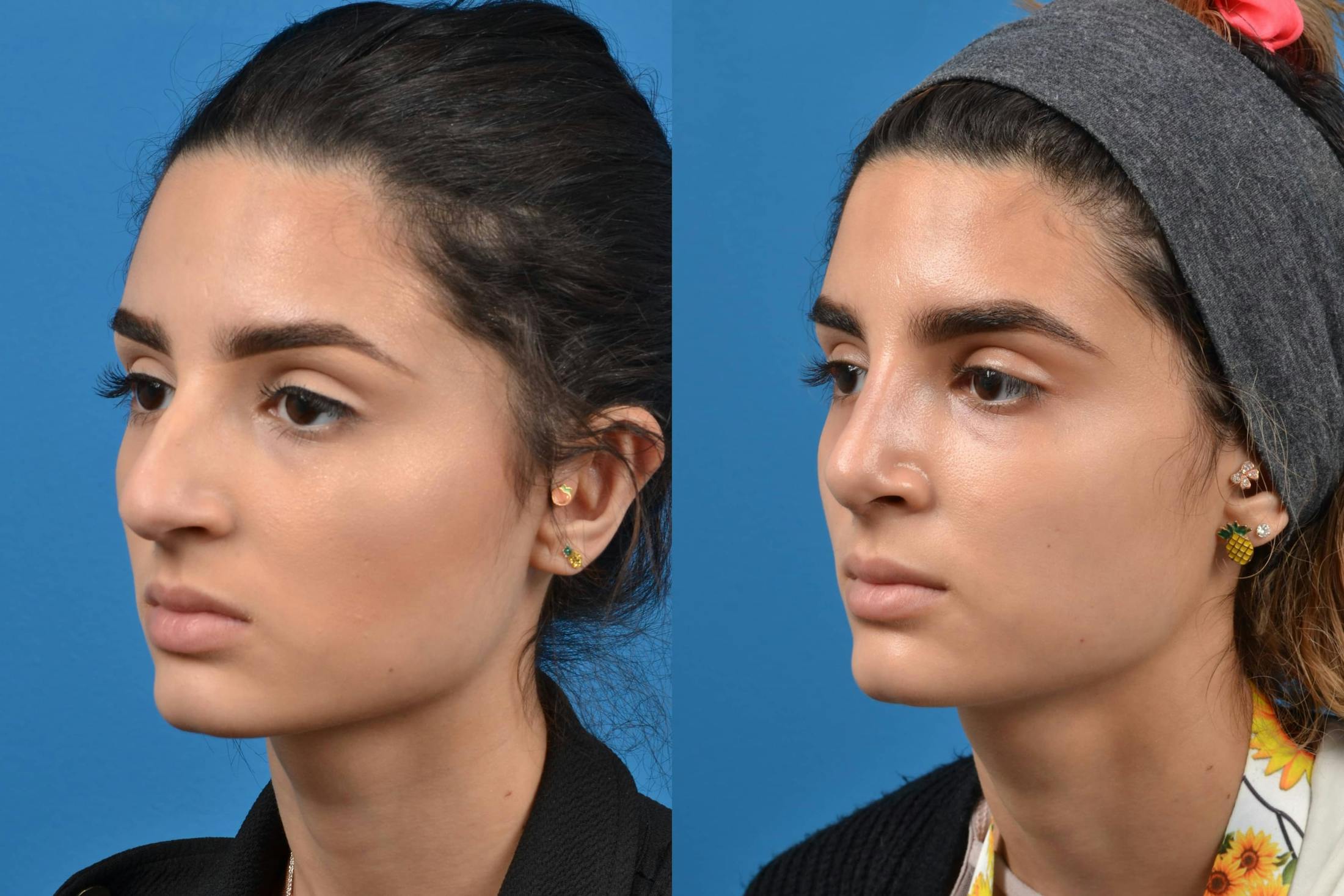 Rhinoplasty Before & After Gallery - Patient 122406535 - Image 4