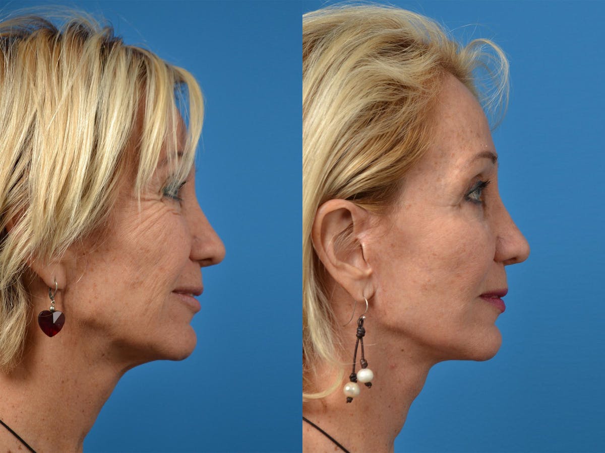 Laser Assisted Weekend Neck Lift Before & After Gallery - Patient 122406533 - Image 4