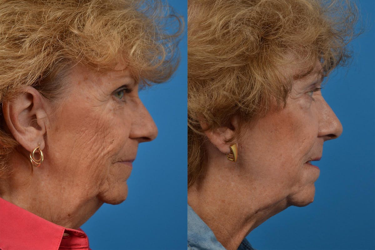 Profile Neck Lift Before & After Gallery - Patient 122406534 - Image 3