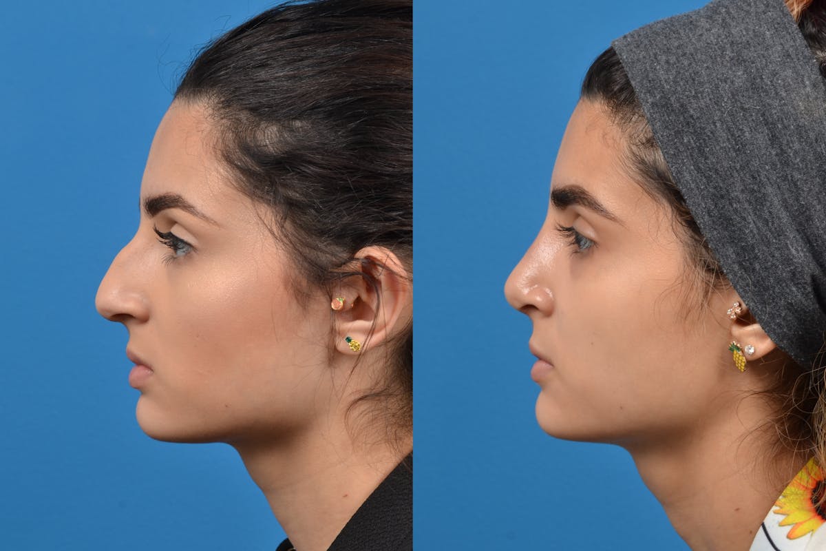 Rhinoplasty Before & After Gallery - Patient 122406535 - Image 5
