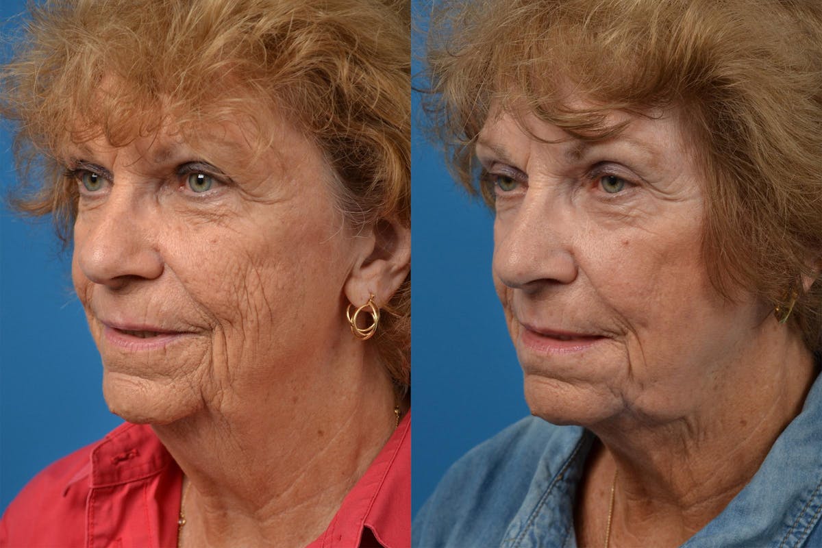 Profile Neck Lift Before & After Gallery - Patient 122406534 - Image 4