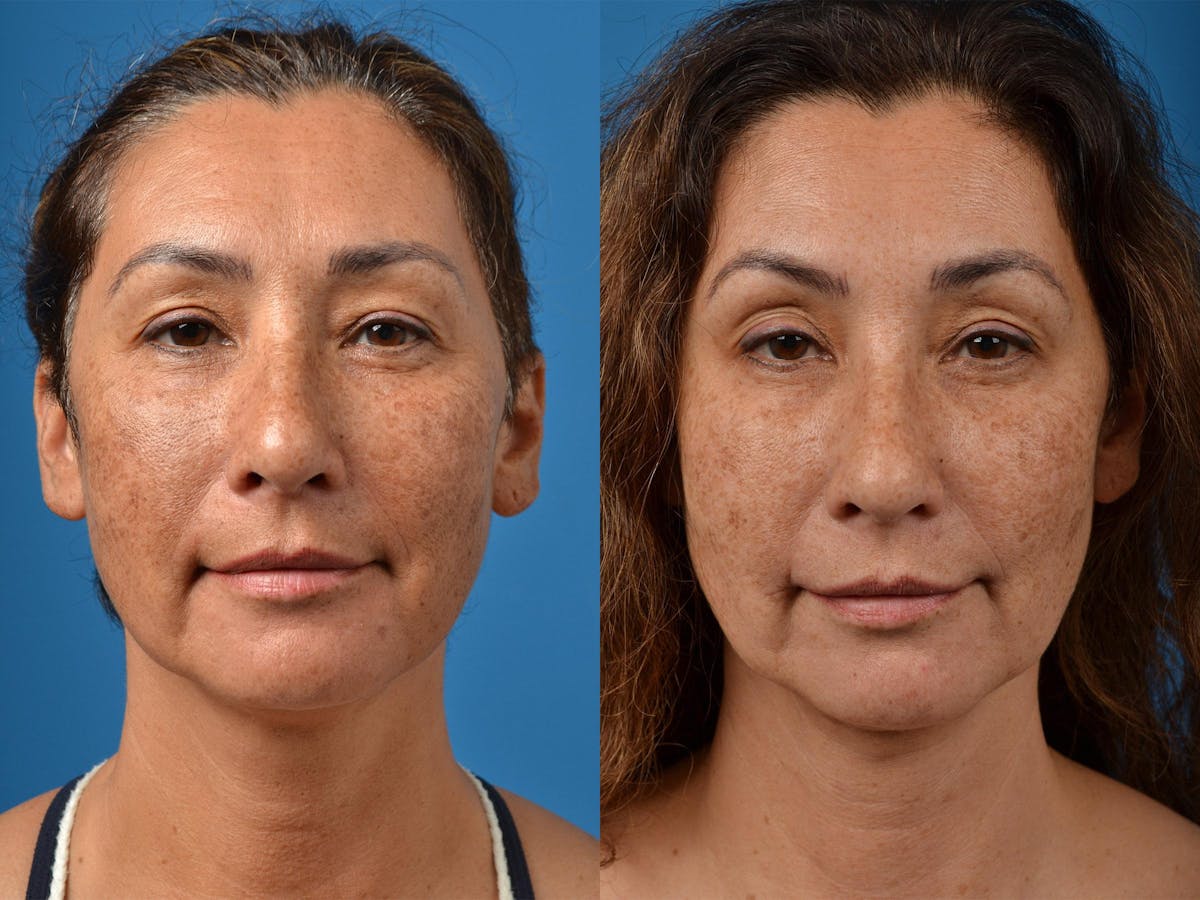 Laser Assisted Weekend Neck Lift Before & After Gallery - Patient 122406537 - Image 1