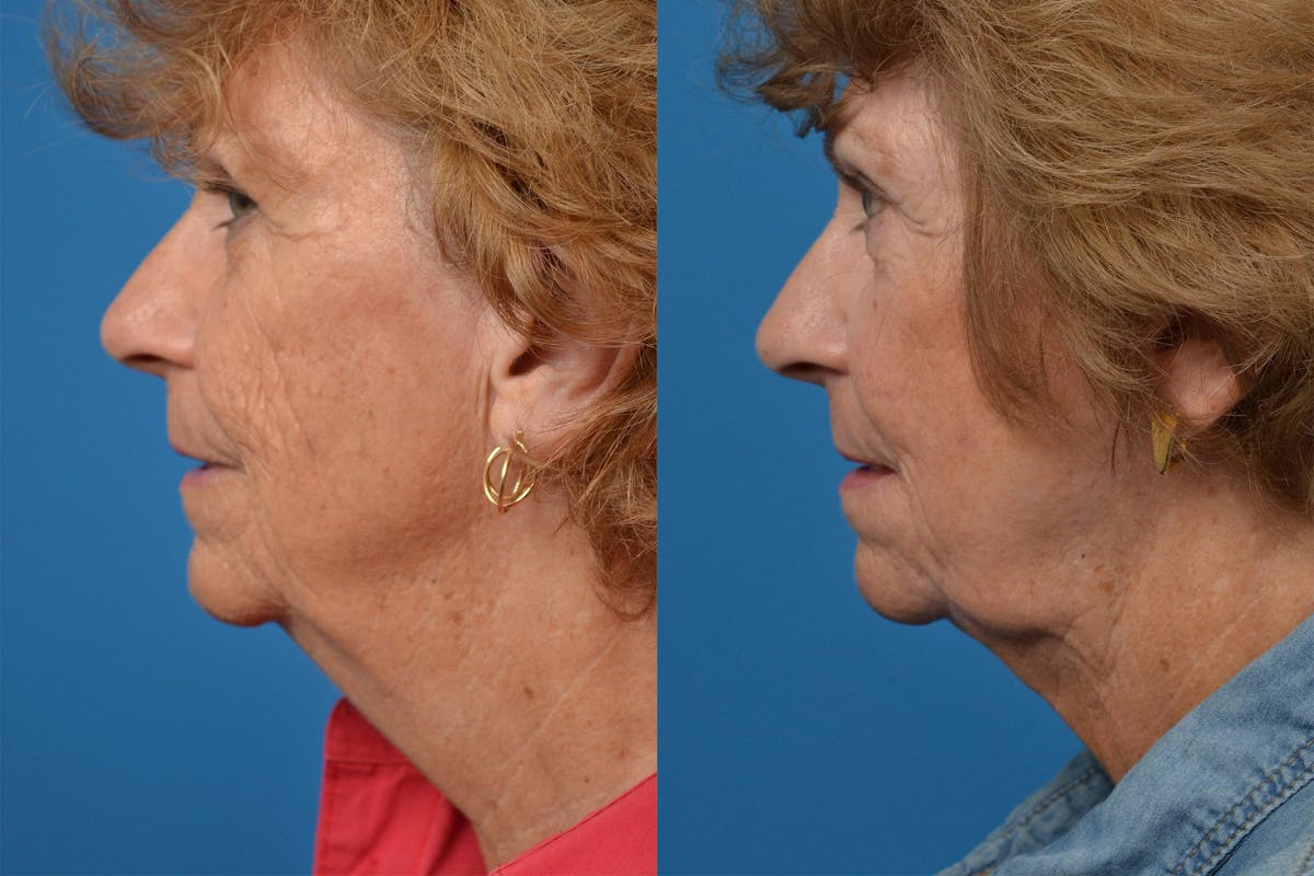 Profile Neck Lift Before & After Gallery - Patient 122406534 - Image 5