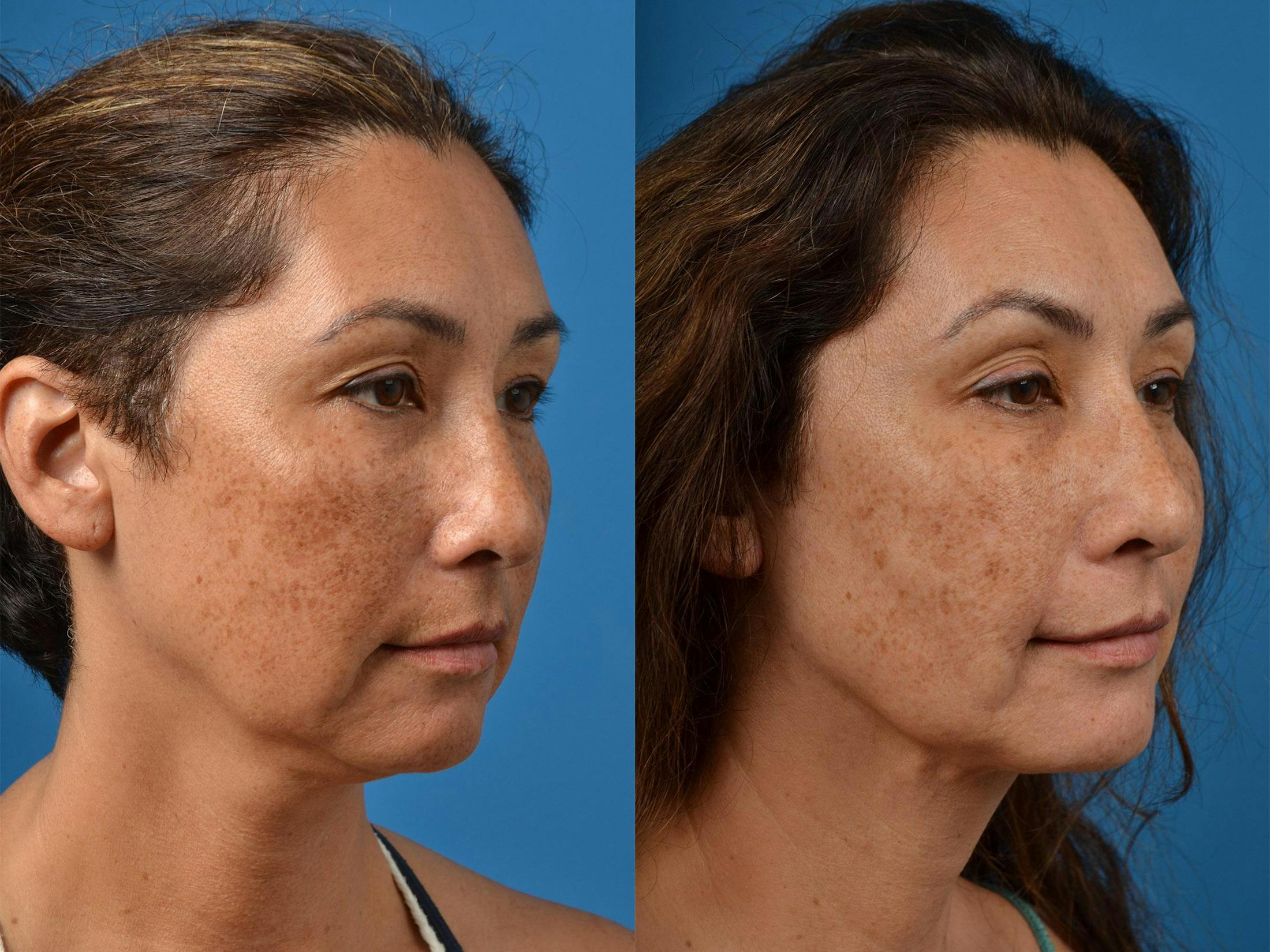 Laser Assisted Weekend Neck Lift Before & After Gallery - Patient 122406537 - Image 2