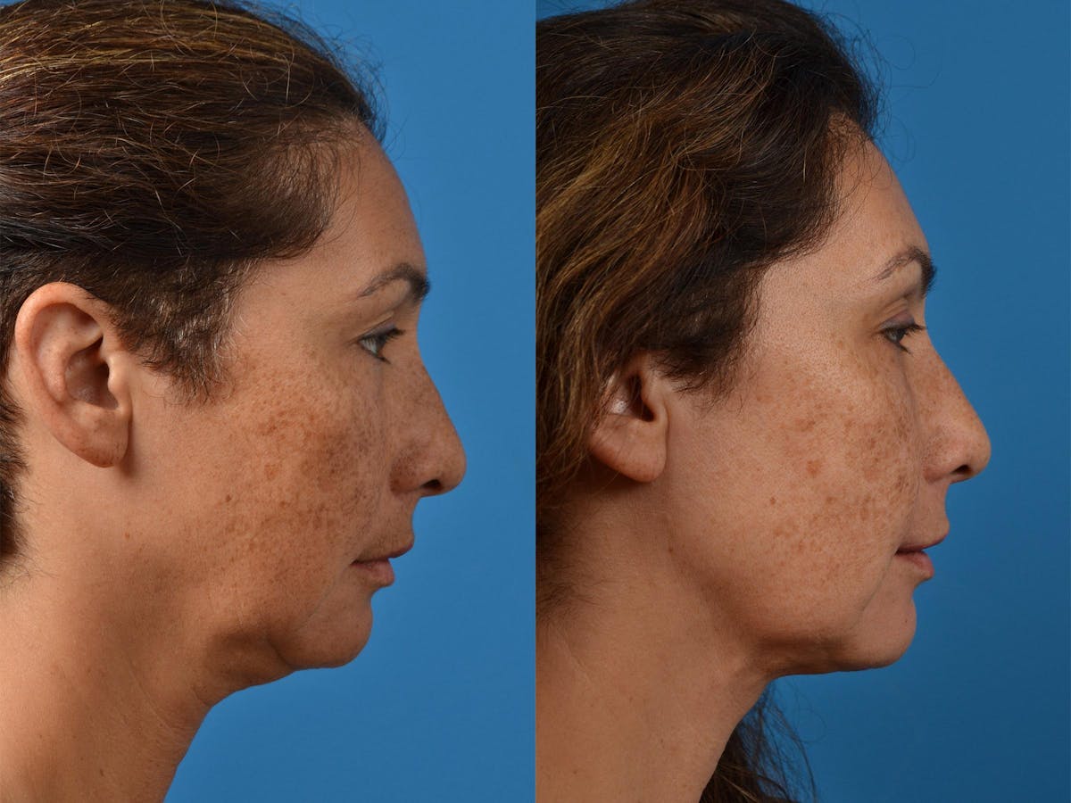 Laser Assisted Weekend Neck Lift Before & After Gallery - Patient 122406537 - Image 3