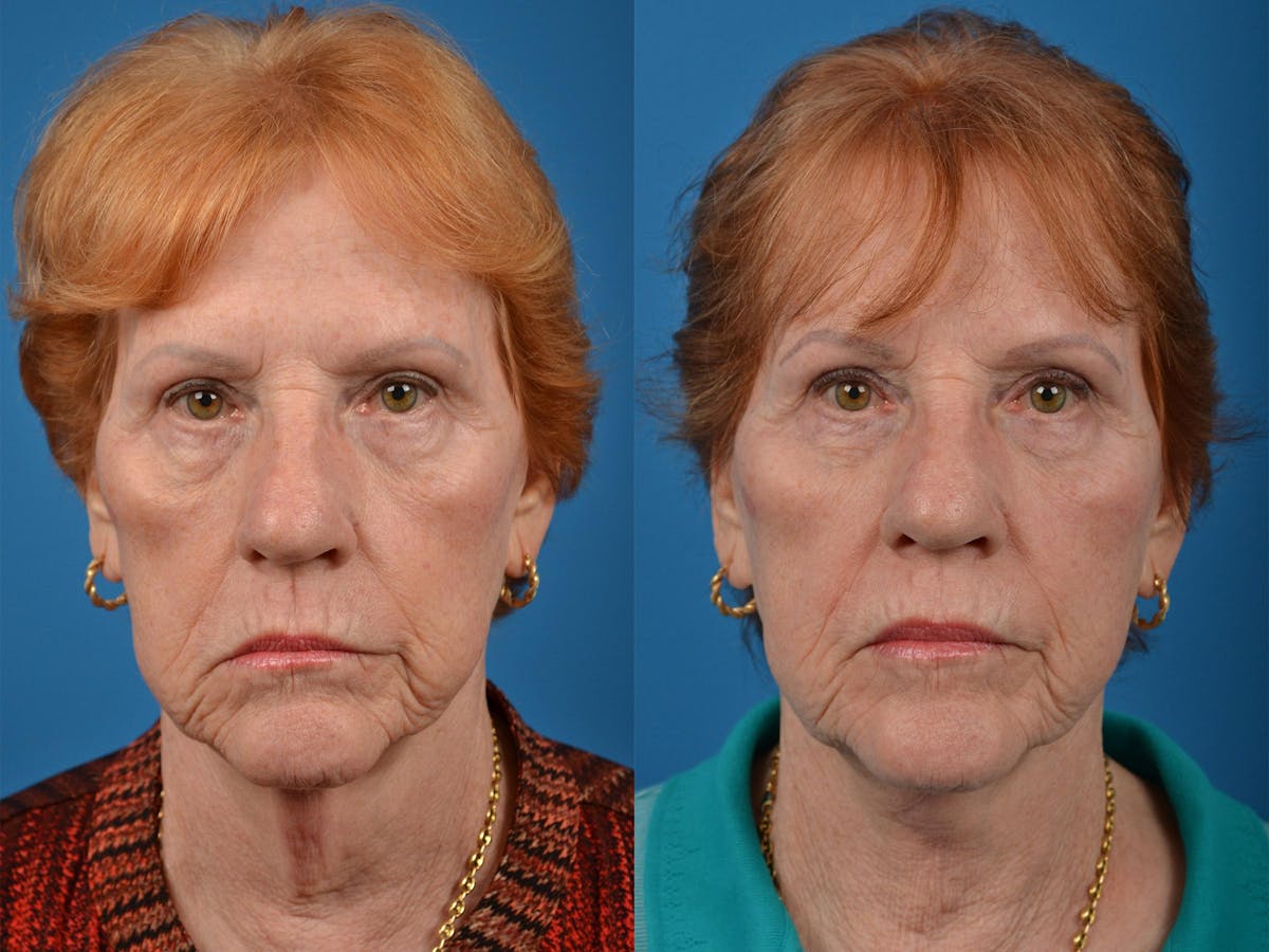 Profile Neck Lift Before & After Gallery - Patient 122406539 - Image 1