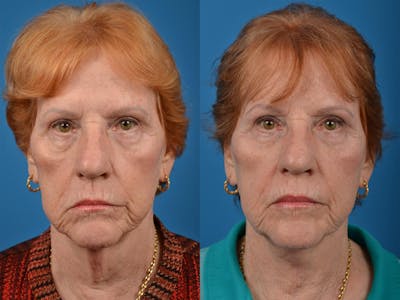 Profile Neck Lift Before & After Gallery - Patient 122406539 - Image 1