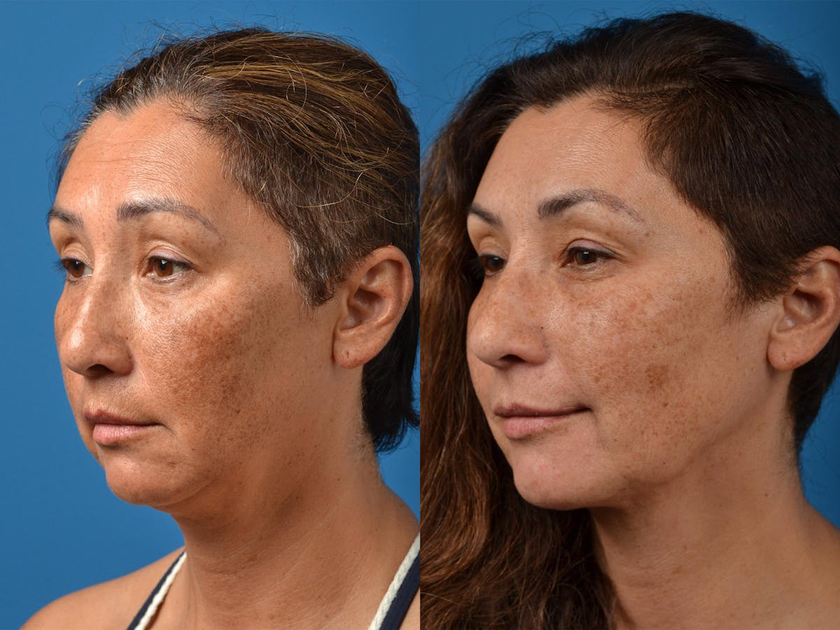 Laser Assisted Weekend Neck Lift Before & After Gallery - Patient 122406537 - Image 4