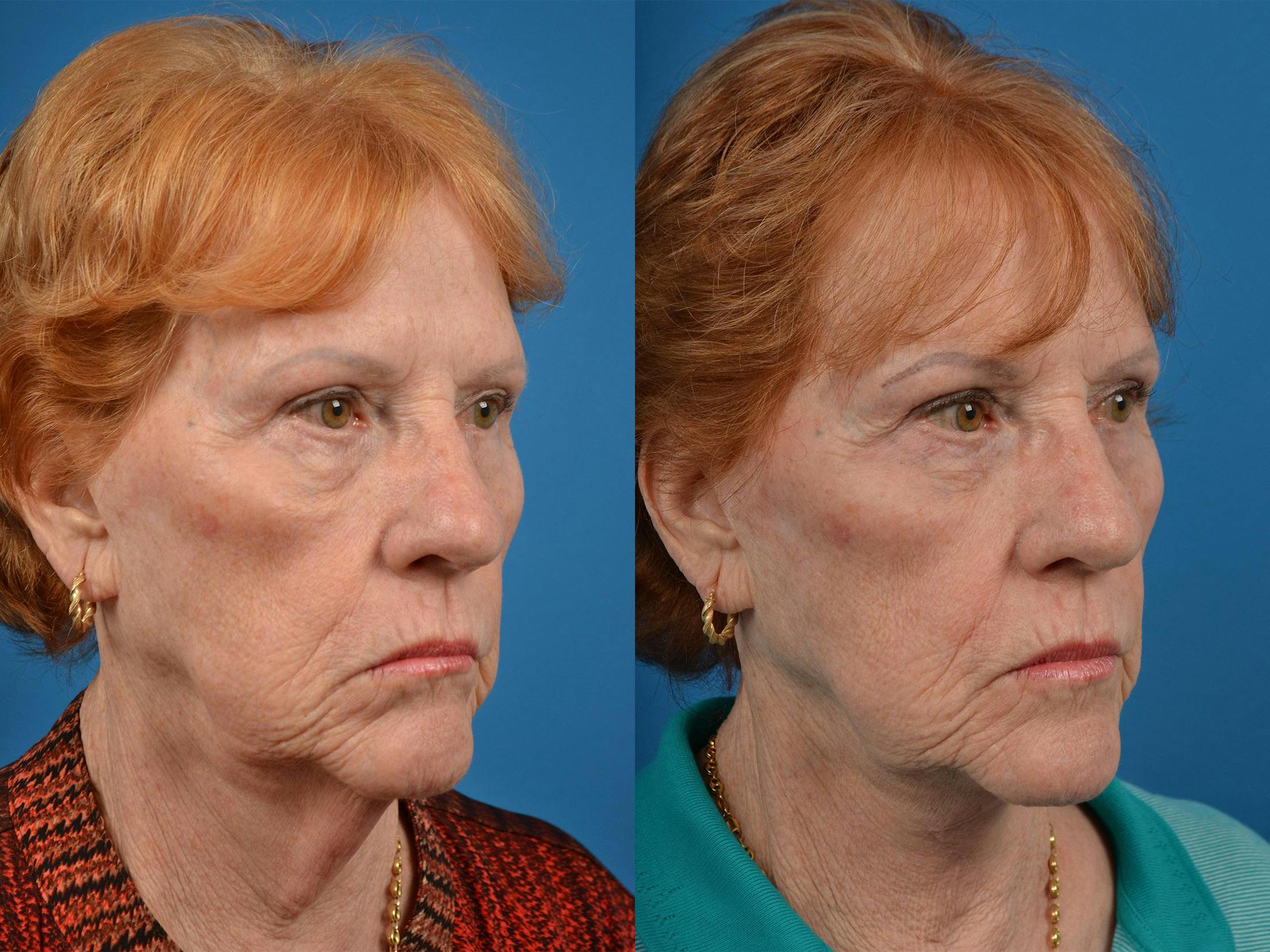 Profile Neck Lift Before & After Gallery - Patient 122406539 - Image 2