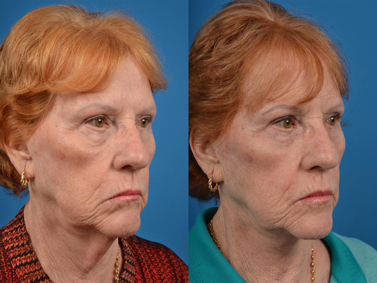 Profile Neck Lift Before & After Gallery - Patient 122406539 - Image 2